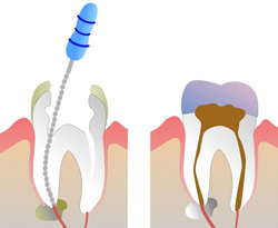 Antalya Endodonti-Kanal Tedavisi